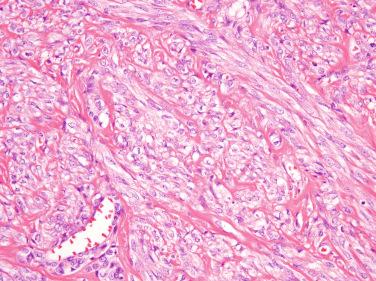 Figure 6.31, Perivascular Epithelioid Cell Tumor.