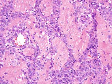 Figure 6.32, Sclerosing Perivascular Epithelioid Cell Tumor.