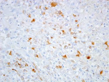 Figure 6.33, Perivascular Epithelioid Cell Tumor.