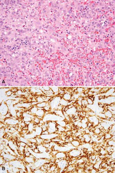 Figure 6.6, Cellular Epithelioid Hemangioma.