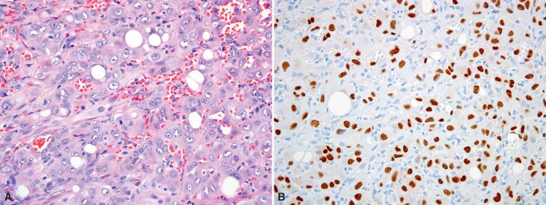 Figure 6.7, Cellular Epithelioid Hemangioma.