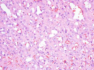 Figure 6.8, Epithelioid Angiomatous Nodule.