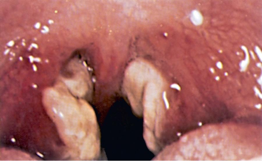 Fig. 281.1, Tonsillitis with membrane formation in infectious mononucleosis.