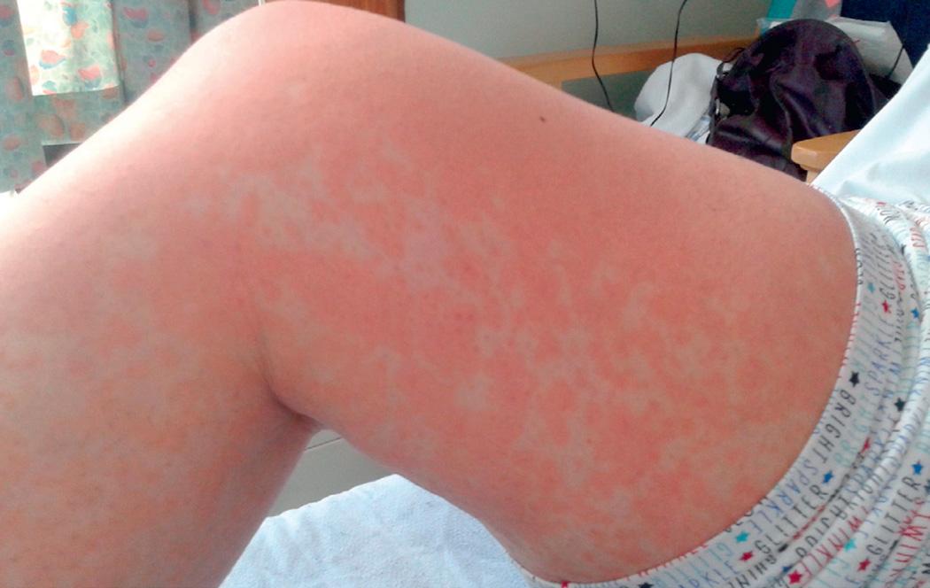 Fig. 281.2, Amoxicillin-induced rash in Epstein-Barr virus infection.