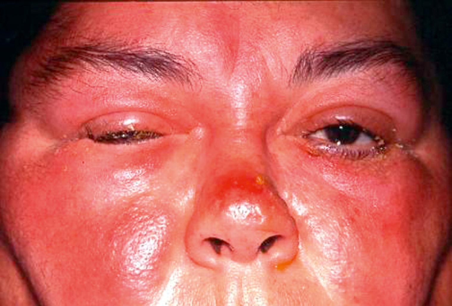 Fig. 19.2, Erysipelas. Note the bright red salmon color of the skin and the well demarcated edge along the nasolabial fold. Erysipelas is a superficial infection and scarring is rare. Infection can occur on the face or lower extremity.