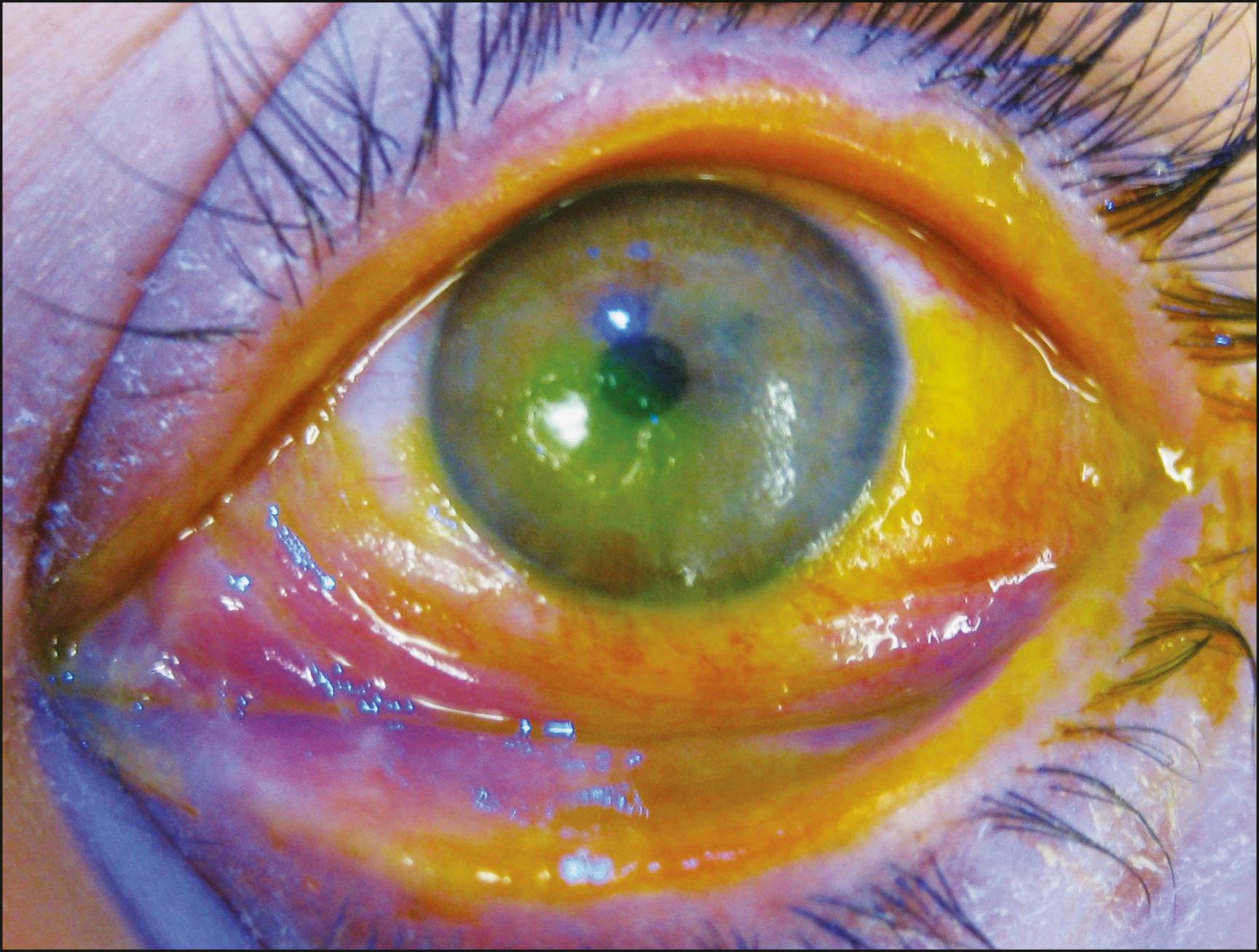 Fig. 46.1, Acute Stevens-Johnson syndrome with severe eye involvement (extensive epithelial sloughing of the lid margins, cornea, bulbar conjunctiva, and tarsal conjunctiva).