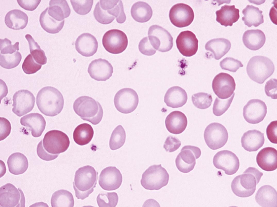 Figure 33.2, Iron deficiency anemia, posttransfusion. The cells are pale with an enlarged central pallor, variation in size, and tendency for elliptocytic formation, in sharp contrast to the transfused normochromic cells.