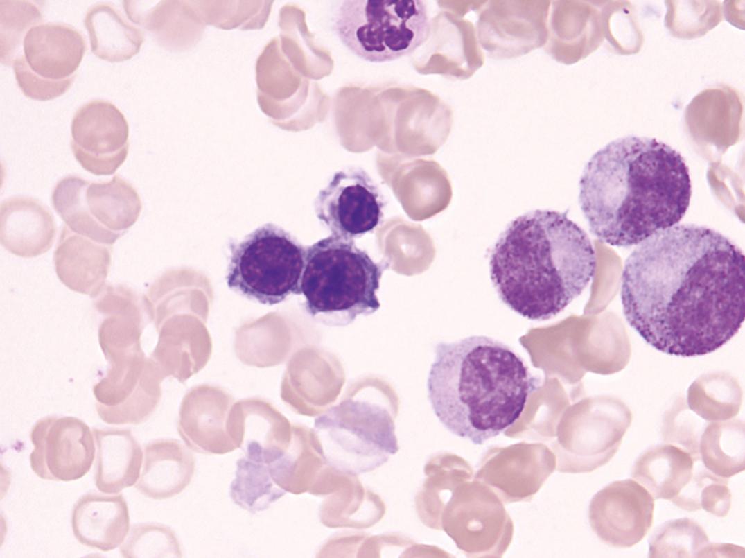 Figure 33.3, Marrow film, iron deficiency anemia. The three normoblasts have irregular margins and irregular clear spaces, reflecting lack of adequate hemoglobin synthesis (i.e., defective cytoplasmic maturation).