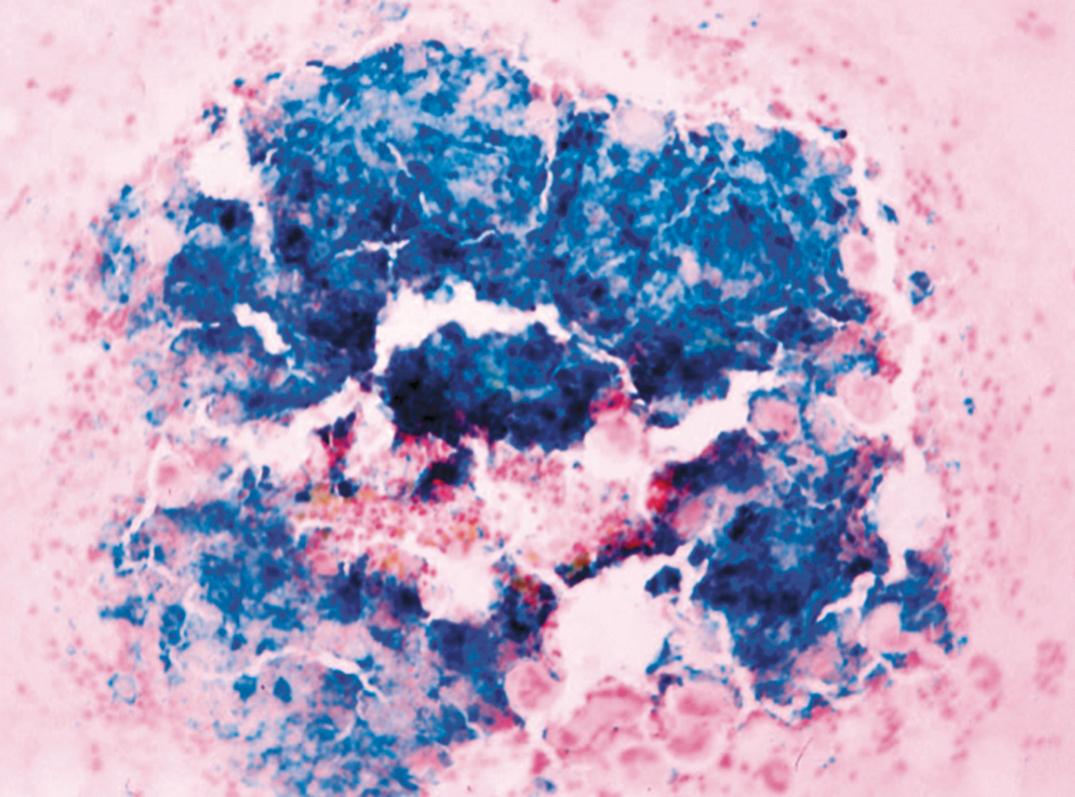 Figure 33.5, Marrow film, Prussian blue reaction. On a scale of 0 to 5+, the amount of storage iron is judged at 5+, which is markedly increased.