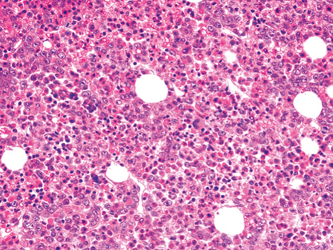 Figure 33.7, Hypercellular marrow in megaloblastic anemia. Cellularity is over 95%.