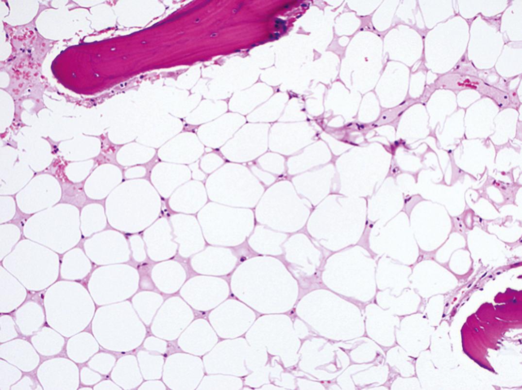 Figure 33.8, Section of hypocellular marrow, aplastic anemia. Cellularity is less than 5%.