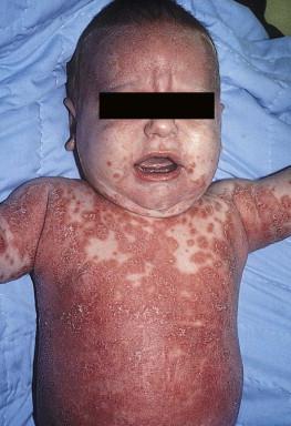 Figure 18.1, Seborrheic dermatitis: widespread erythema and scale.