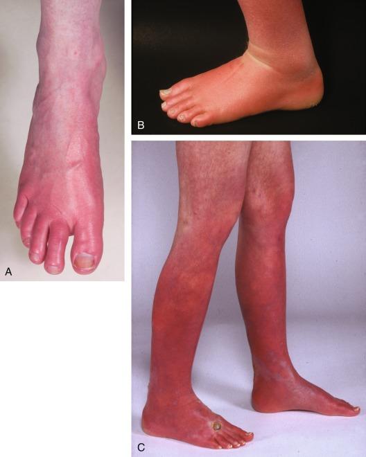 Fig. 48.1, Erythromelalgia (red, hot, acral areas) involving lower extremities may affect toes only, distal forefoot (A), or entire foot (B) or may extend up the leg, even beyond the knee (C). It is usually bilateral (C).