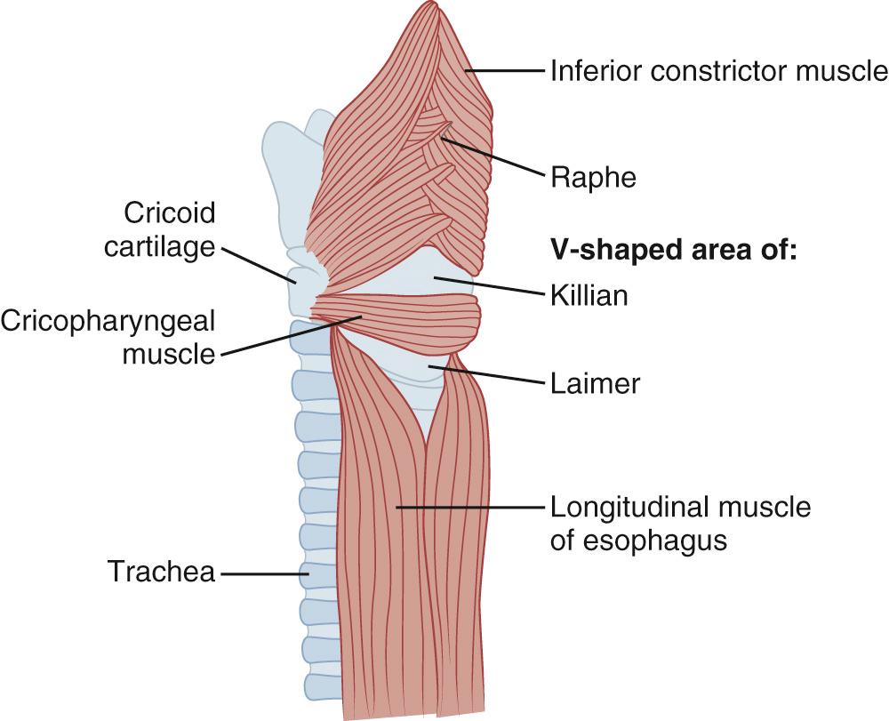 FIGURE 34-2, Muscular architecture of the pharyngoesophageal junction, which is the region of the upper esophageal sphincter. The triangular areas of the sparse muscle cover are shown in the scheme. Zenker diverticulum arises from Killian triangle.
