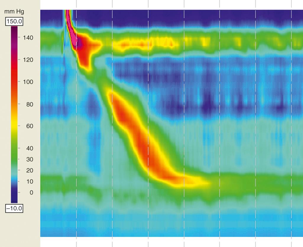 FIGURE 2.1, Normal peristalsis.