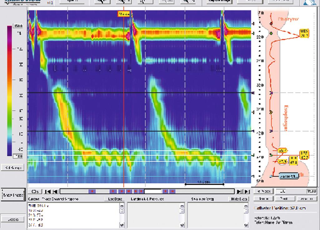 FIGURE 3.2, High-resolution manometry showing the esophageal pressure tracing during three swallows. The lower esophageal sphincter is the high-pressure zone defined by an increase of 2 mm from baseline esophageal pressure at the proximal end and from baseline gastric pressure at the distal end. The lower esophageal sphincter relaxes during the swallow and regains its resting pressure between swallows.