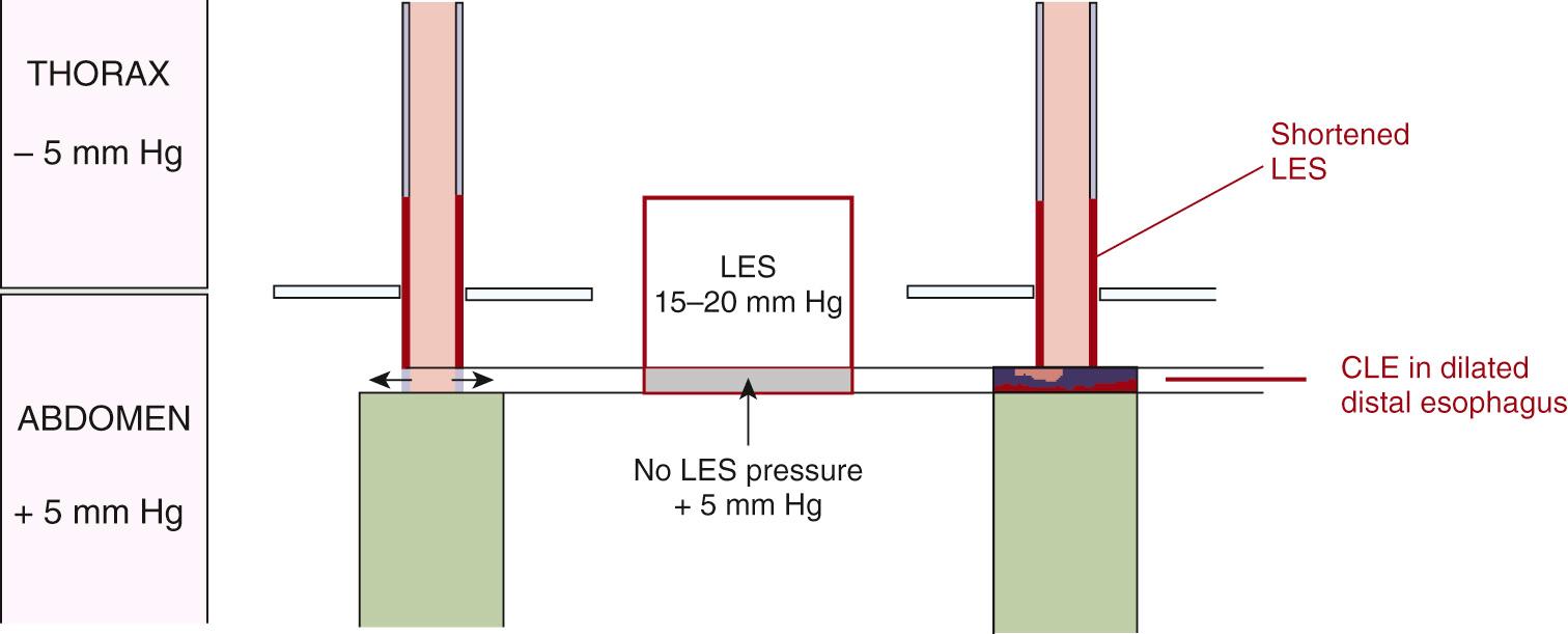 FIGURE 3.3, Effect of loss of pressure in the abdominal segment of the lower esophageal sphincter (LES) . The normal resting pressure of the abdominal LES overcomes the positive intraluminal pressure in the abdominal esophagus and maintains the tubal shape of the esophagus. When the LES pressure is lost, the intraluminal pressure causes this part of the distal esophagus to dilate. CLE, Columnar lined esophagus.