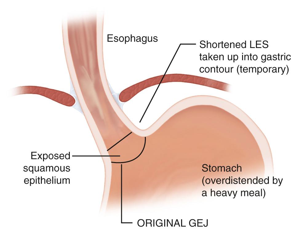 FIGURE 3.4, Mechanism of exposure of the squamous epithelium of the distal esophagus to acid. When the stomach overdistends with a heavy meal, the lower esophageal sphincter shortens, the distal lower esophageal sphincter becomes effaced (i.e., moves down into the contour of the gastric fundus), and the squamous epithelium becomes exposed to gastric contents of the full stomach. There is, at the top of the food column, an acid pocket that meets the descending squamous epithelium. GEJ, Gastroesophageal junction.