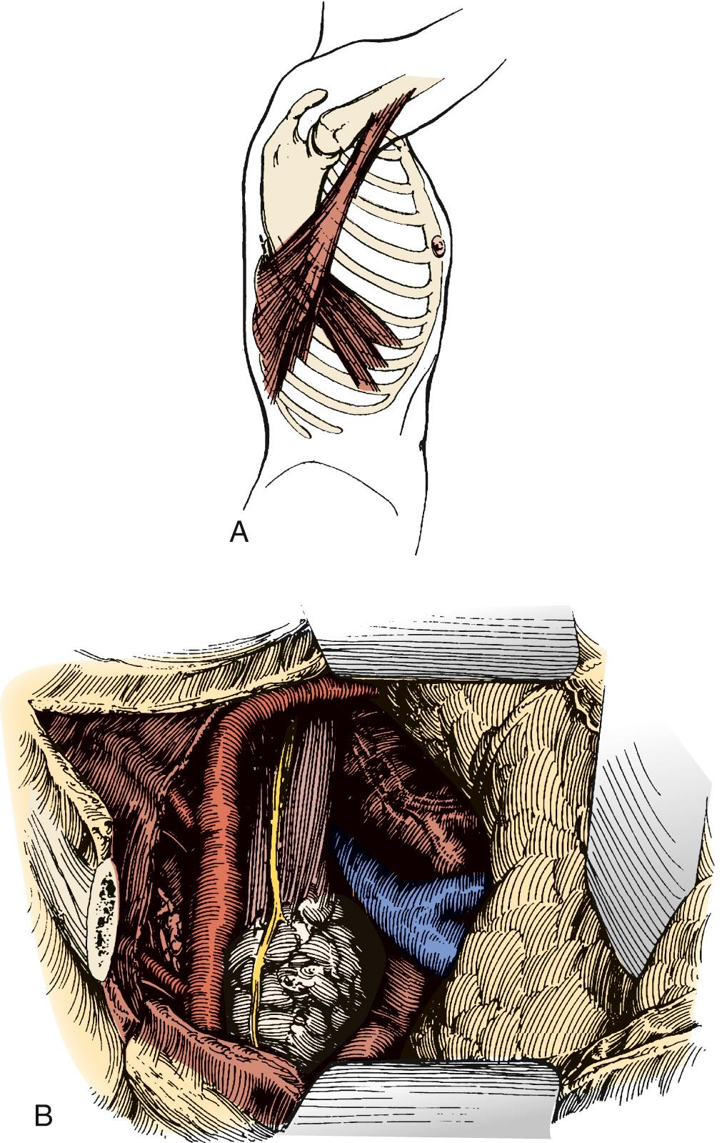 FIGURE 38-1, A, A limited right posterolateral thoracotomy is performed, dividing the latissimus. B, View of the esophagus with tumor through the incision.