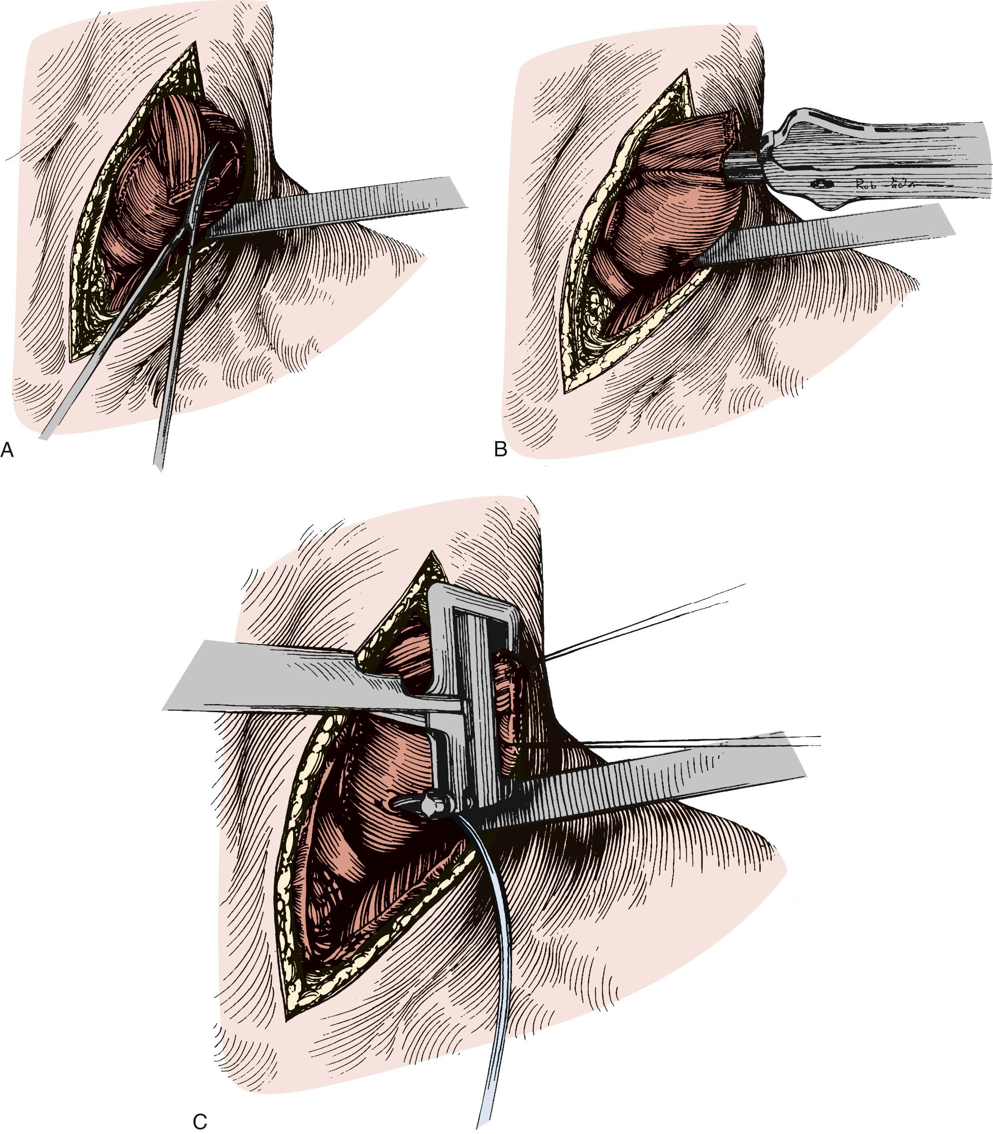 FIGURE 38-11, A, A corner of the proximal esophageal staple line is trimmed, and an enterotomy is made in the proximal gastric conduit away from the staple line. B, A gastrointestinal anastomosis stapler is used to create the back wall of the cervical anastomosis. Additional length may be obtained with an additional fire of an endoscopic 30-mm stapler. C, The anterior wall of the anastomosis is closed with a thoracoabdominal stapler. In this illustration, a gastric drainage tube exits through the neck. These tubes can be used in place of a nasogastric tube and are more comfortable for the patient.