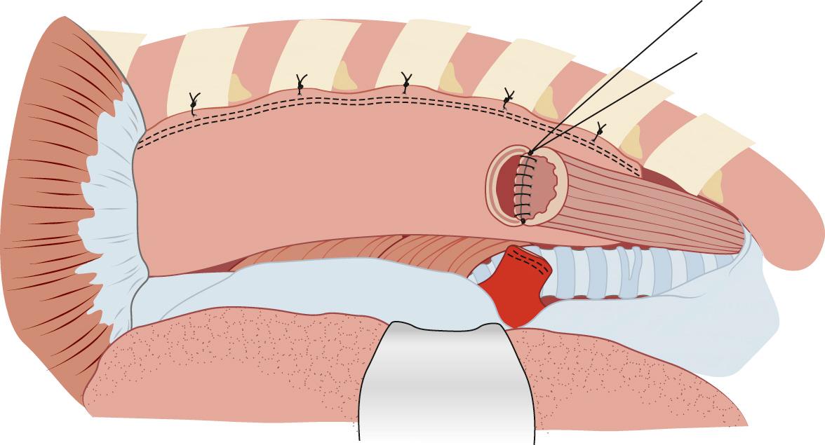 FIGURE 38-12, The Ivor Lewis anastomosis is performed at the level of the azygos vein, in two layers, after creation of a circular enterotomy in the proximal conduit. The edges of the conduit are shown here tacked to the pleura, although it is debatable whether this effectively reduces tension on the anastomosis.