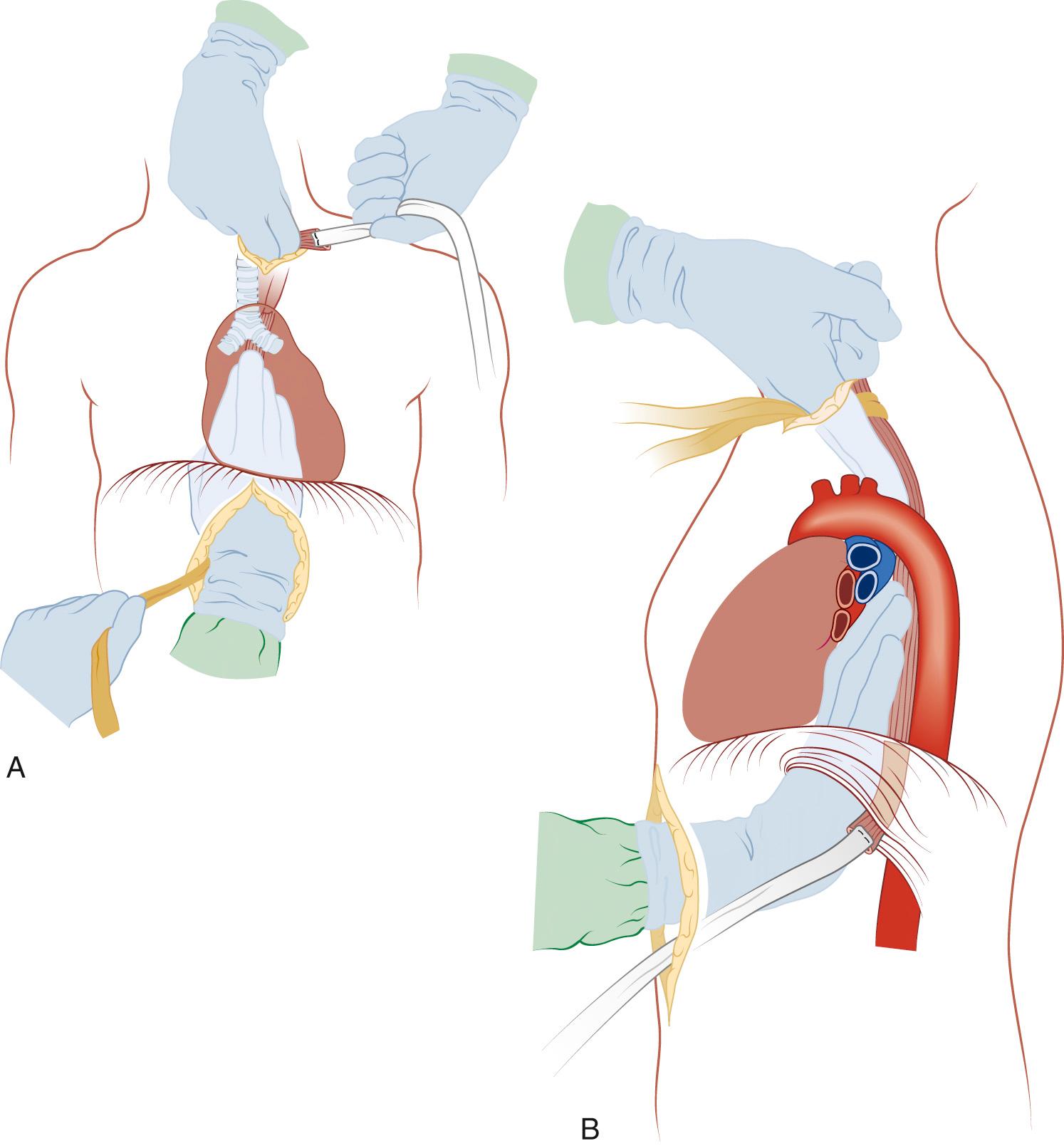 FIGURE 38-14, A, Blunt dissection of the esophagus off of the trachea is performed with the fingertips immediately against the esophagus. B, The fingertips are united. The fingertips from above should be able to reach near the carina, as they do during cervical mediastinoscopy.