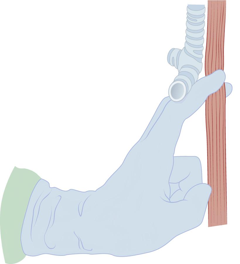 FIGURE 38-15, After dissection of the anterior and posterior planes, the lateral stalks can be torn between the first and second fingers in a “raking” motion.