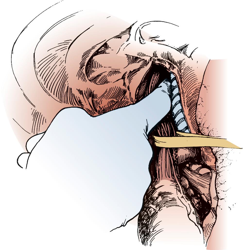 FIGURE 38-2, Blunt finger dissection close to the esophagus is used to free the esophagus up into the neck.