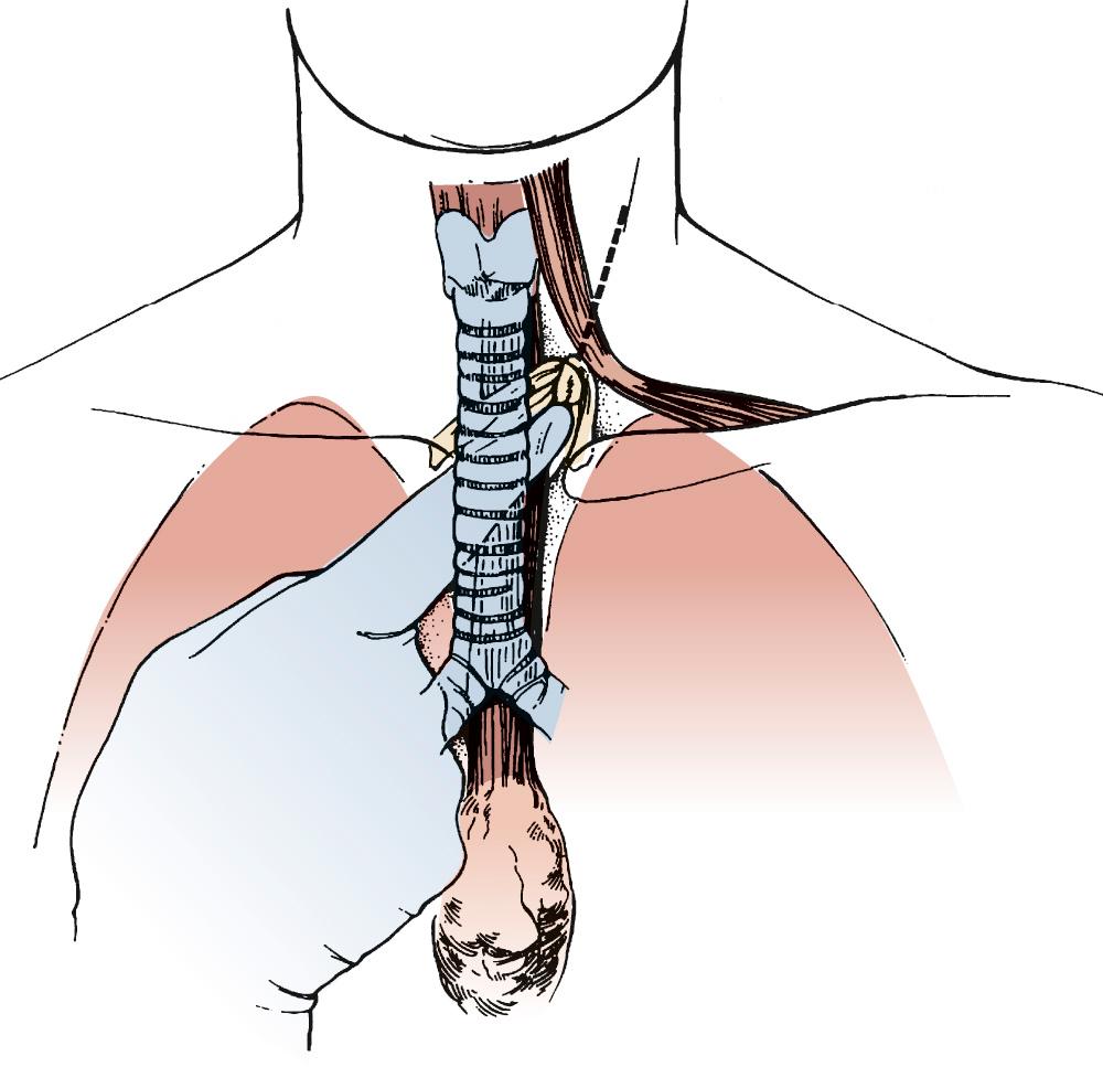 FIGURE 38-3, A knotted Penrose drain is placed into the left side of the neck for later retrieval during the cervical dissection. This helps ensure isolation of the esophagus without injury to the recurrent nerves.