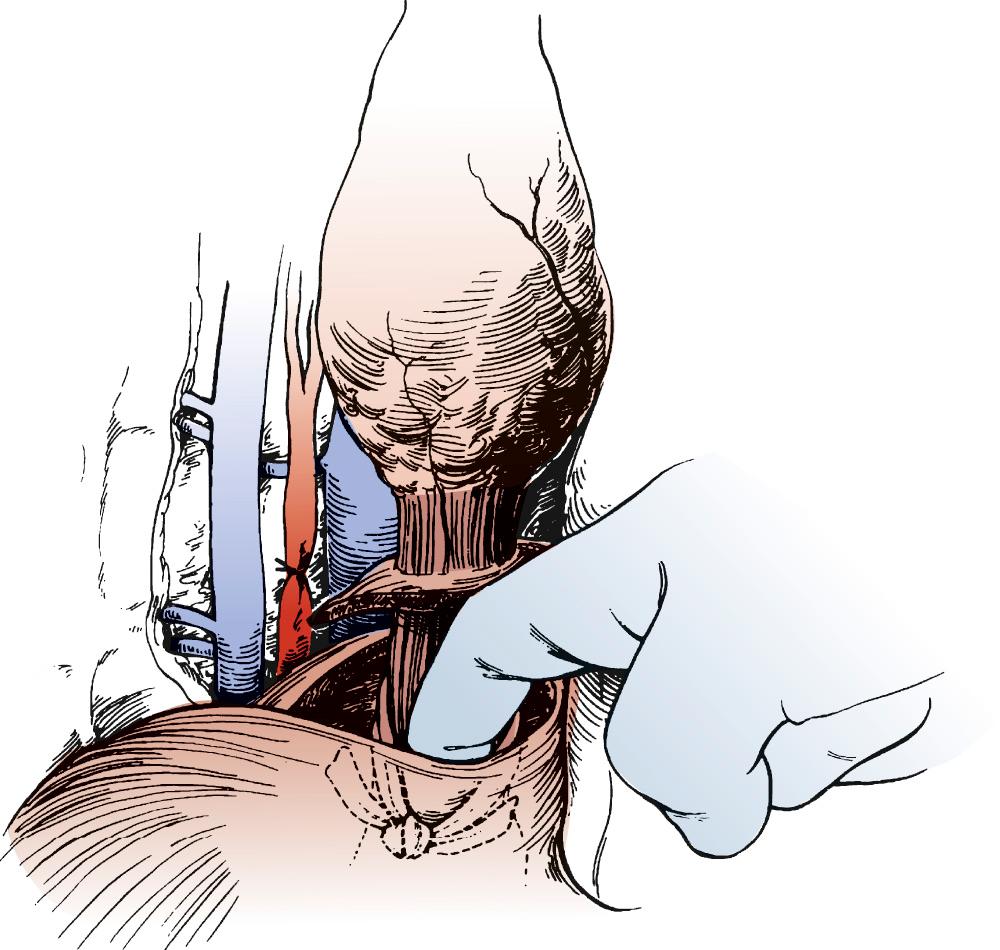 FIGURE 38-4, A rim of diaphragm is incorporated into the specimen for all gastroesophageal junction tumors. A knotted Penrose drain is placed into the abdomen to aid dissection of the esophagus at the gastroesophageal junction during the abdominal phase of the operation.