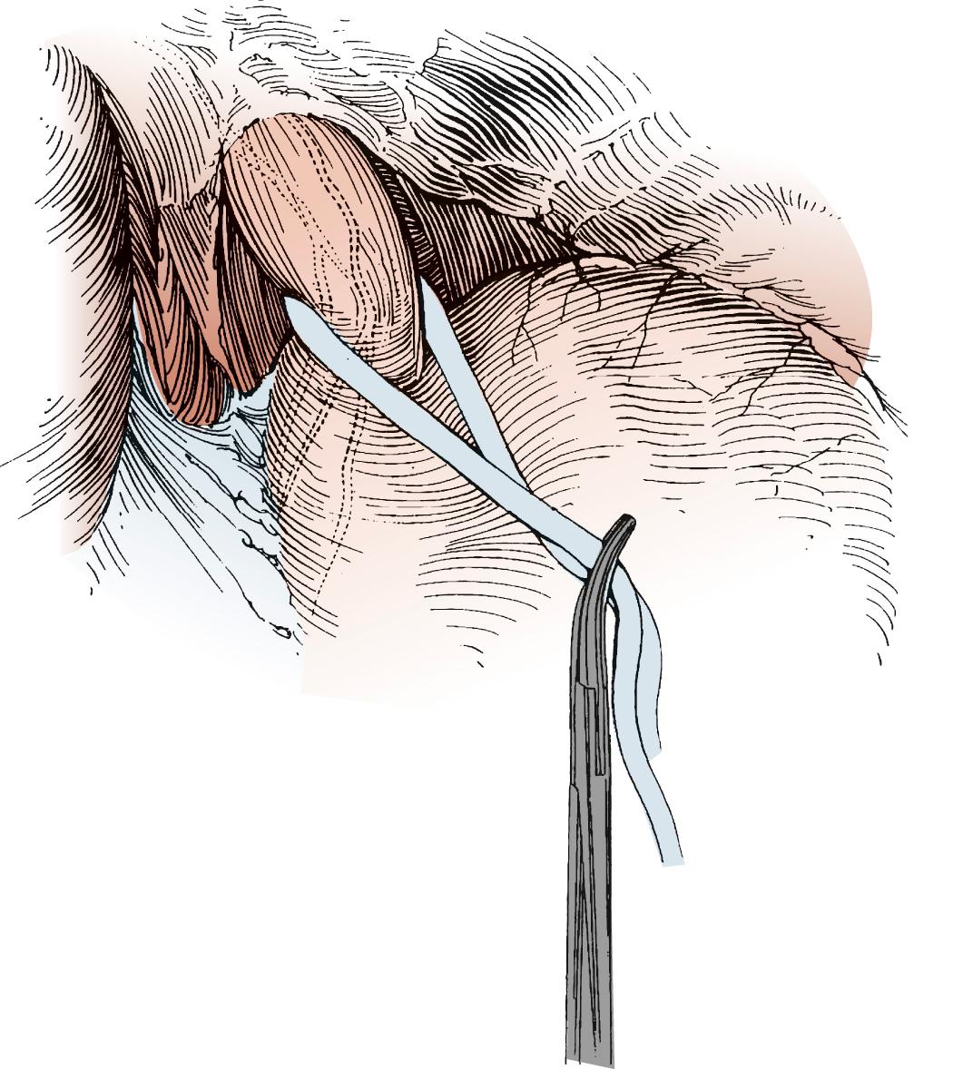 FIGURE 38-5, The phrenoesophageal ligament is divided fully after retrieval of the Penrose drain.