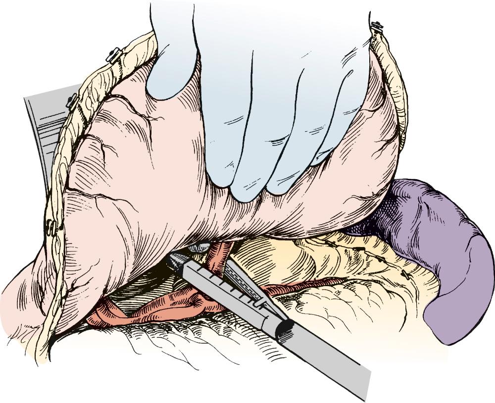 FIGURE 38-6, After complete mobilization of the greater curvature of the stomach and division of the gastrohepatic ligament, the left gastric vessels are identified. An endoscopic vascular stapler is used to divide these vessels, with care taken not to impinge on the celiac axis.