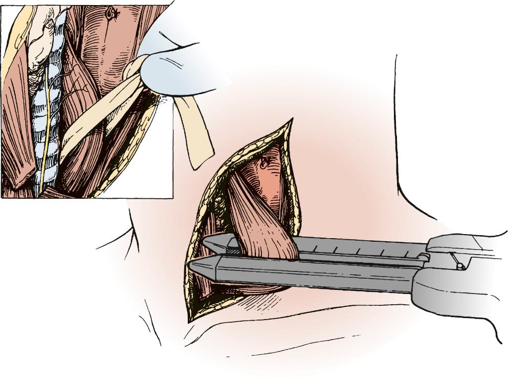 FIGURE 38-7, Retrieval of the Penrose drain placed around the esophagus inside the recurrent nerves during chest dissection. This aids in the prevention of recurrent nerve injury. The esophagus is divided after removal of the nasogastric tube.