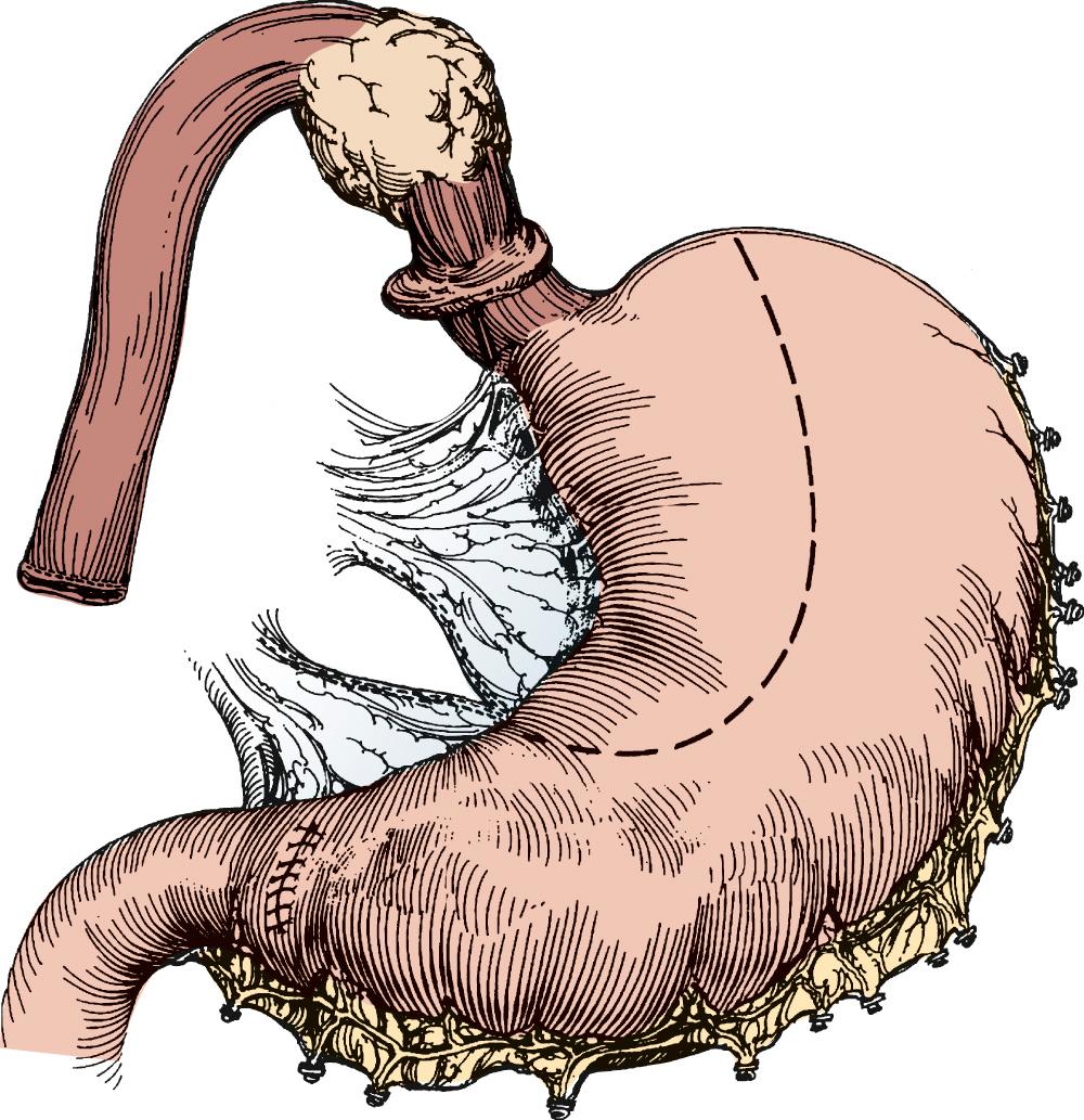 FIGURE 38-8, The gastric tube is created after complete dissection of the stomach and after the cervical esophagus is divided and brought into the abdomen. The gastric tube should be kept at least 5 cm in diameter. This also allows longer margins for gastroesophageal junction tumors. A pyloroplasty has been performed.