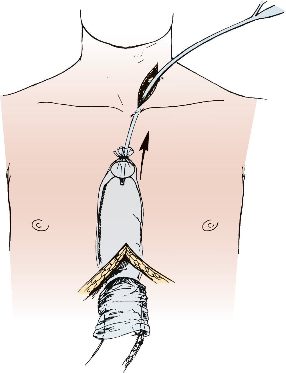 FIGURE 38-9, An endoscopic camera bag is used as an atraumatic means of drawing the conduit into the neck for anastomosis. Suction is applied to the Foley catheter as it is pulled into the neck.