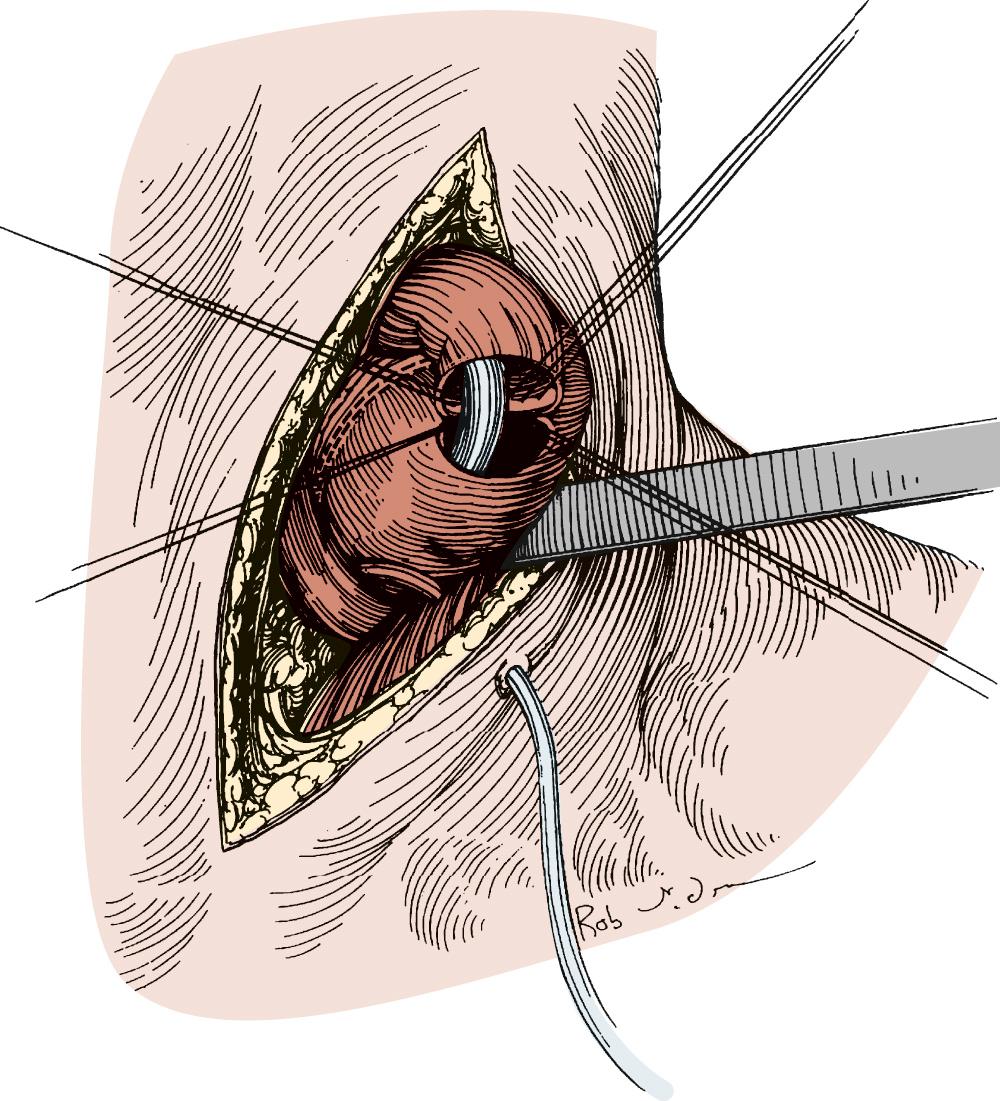 FIGURE 38-10, The cervical anastomosis may be hand sewn with interrupted silk sutures over a nasogastric tube.