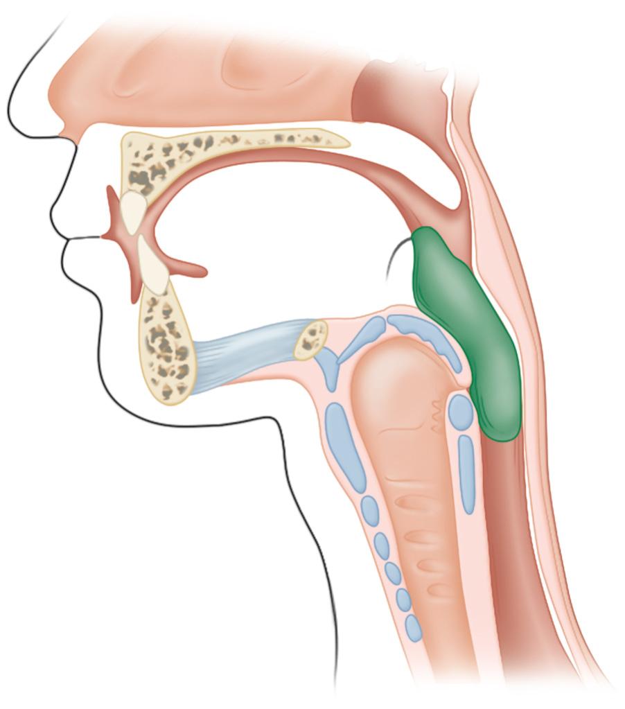 FIGURE 1.2, The swallowing process: The soft palate is lifted upward toward the hard palate, thus closing off the nasopharynx. The tongue pushes the bolus backward into the pharynx. The hyoid bone and the larynx are pulled upward, thus causing the epiglottis to flip down and close off the trachea. The upper esophageal sphincter relaxes to prepare the passage of the bolus.