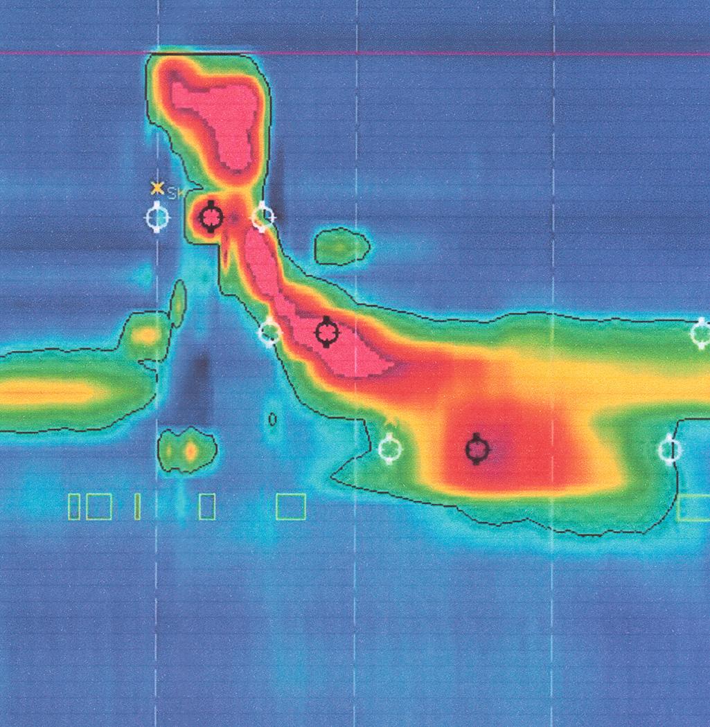 FIGURE 1.4, High-resolution manometry of the pharynx and upper esophageal sphincter (UES) in a healthy individual. The contraction of the soft palate, subsequent pharyngeal contraction, and relaxation of the UES is demonstrated. In addition, the pressurization proximal to the original level of the UES can be noticed, reflecting the upward movement of the larynx and the UES during the closure of the airways.
