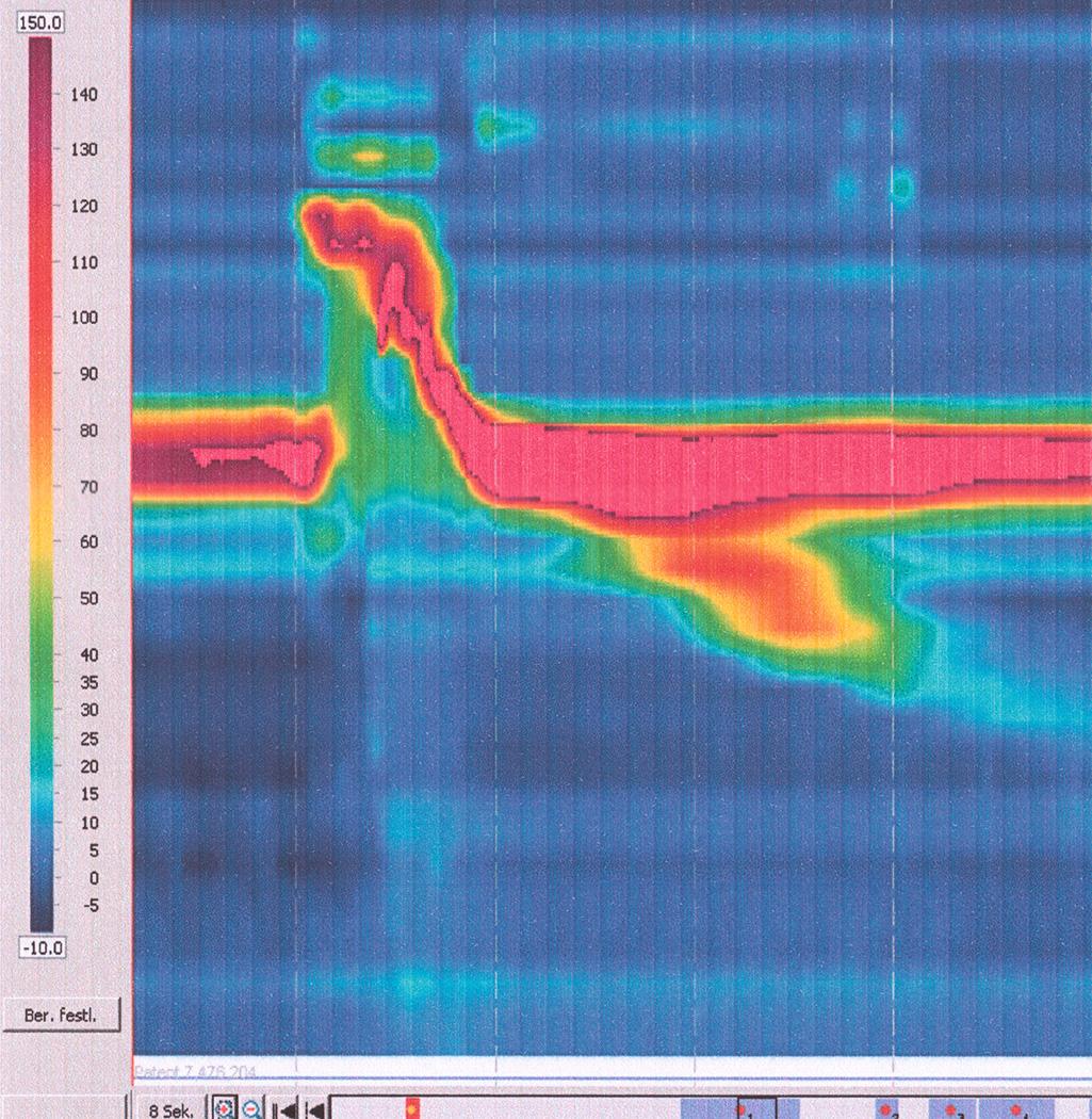 FIGURE 1.5, High-resolution manometry of the pharynx and upper esophageal sphincter in a patient with dysphagia, based on insufficient relaxation of the upper esophageal sphincter and hypertensive contractions because of a neurologic disorder.