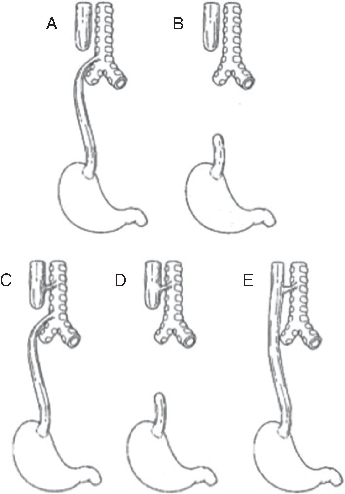 Fig. 86.1, The Five Described Anatomic Configurations of Esophageal Atresia and Tracheoesophageal Fistula .