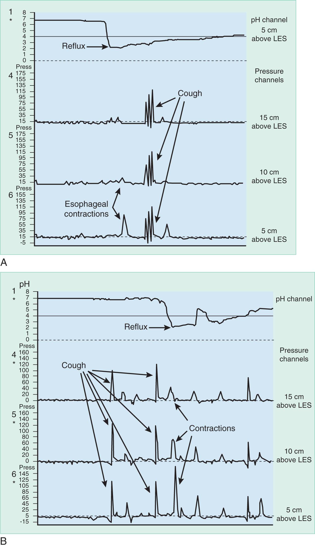 FIGURE 5.1, Cause-and-effect relationship between cough and esophageal acid exposure. (A) Coughing precipitated by a reflux episode may be the result of occult aspiration of refluxed gastric juice or a reflex brought on by esophageal acidification. (B) Conversely, increased intraabdominal pressure, as occurs with coughing, may overcome antireflux mechanisms and result in a gastroesophageal reflux episode. LES , Lower esophageal sphincter.