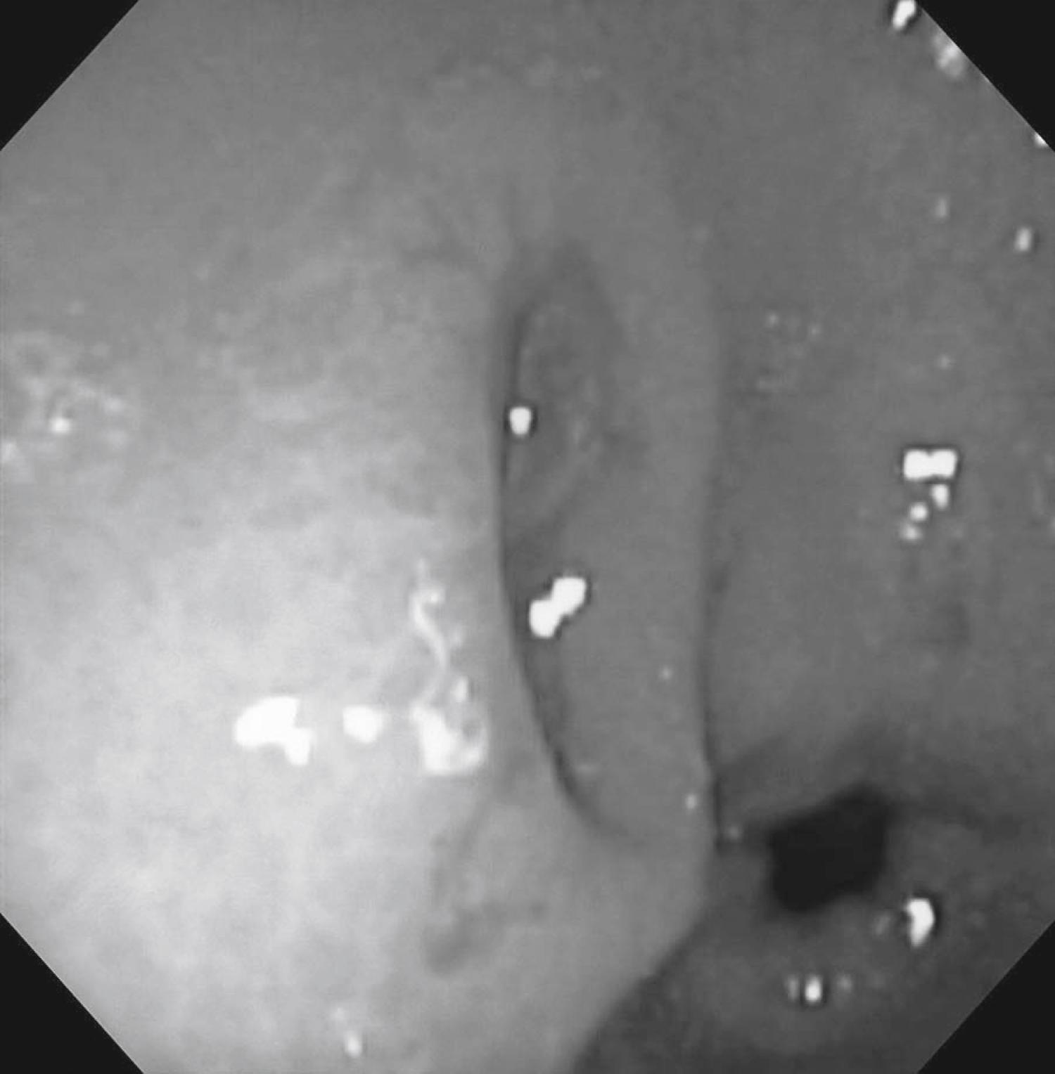 Fig. 60.11, Endoscopic Appearance of Gastric Posttransplantation Lymphoproliferative Disease in a 1-Year-Old Following Liver Transplantation on Tacrolimus Immunosuppression.