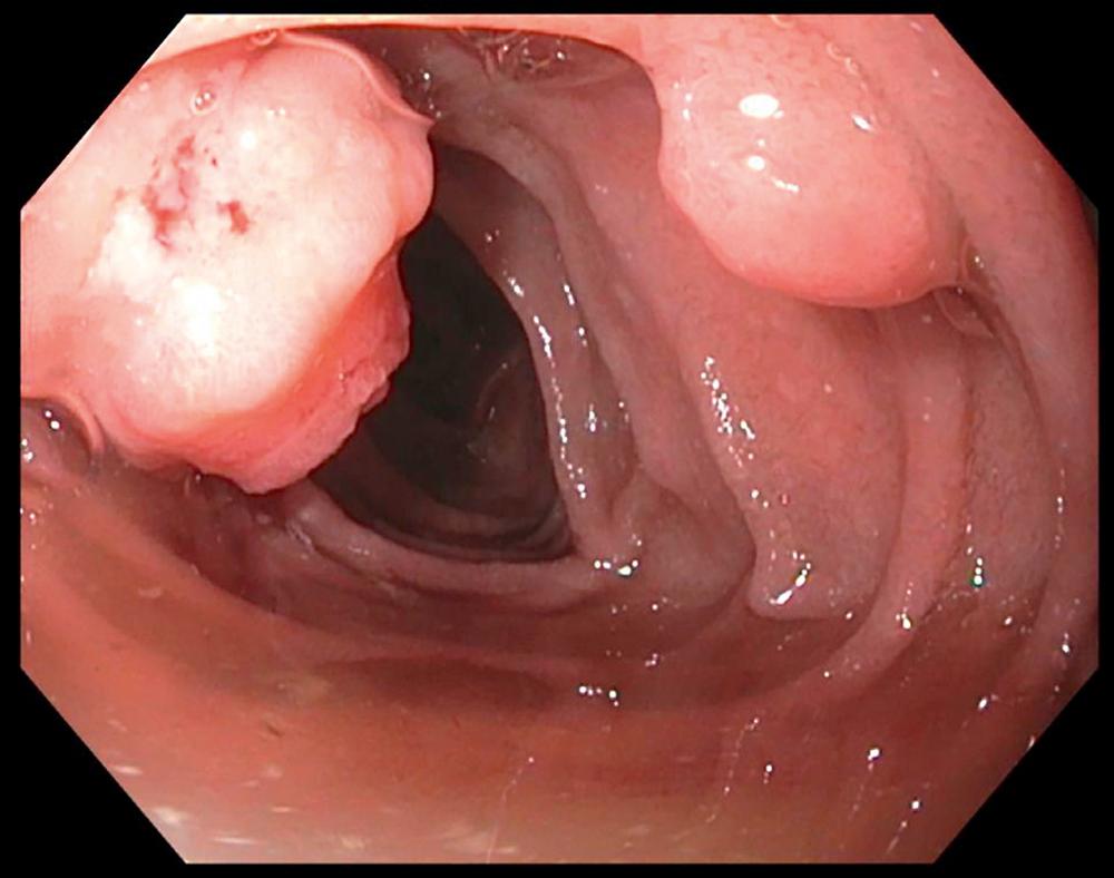 Fig. 60.2, Endoscopic image illustrating the major (left) and minor (right) duodenal papillae visualized at the time of endoscopic screening in a patient with familial adenomatous polyposis (FAP). The major papilla was biopsied as part of FAP screening.