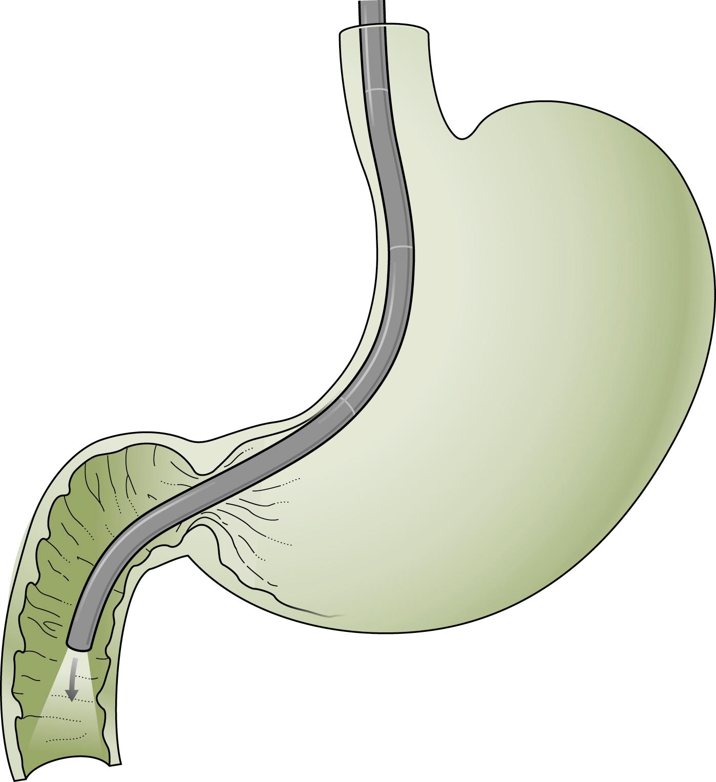 Fig. 60.4, Duodenal straightening maneuver that paradoxically advances the endoscope into the distal duodenum by scope withdrawal.