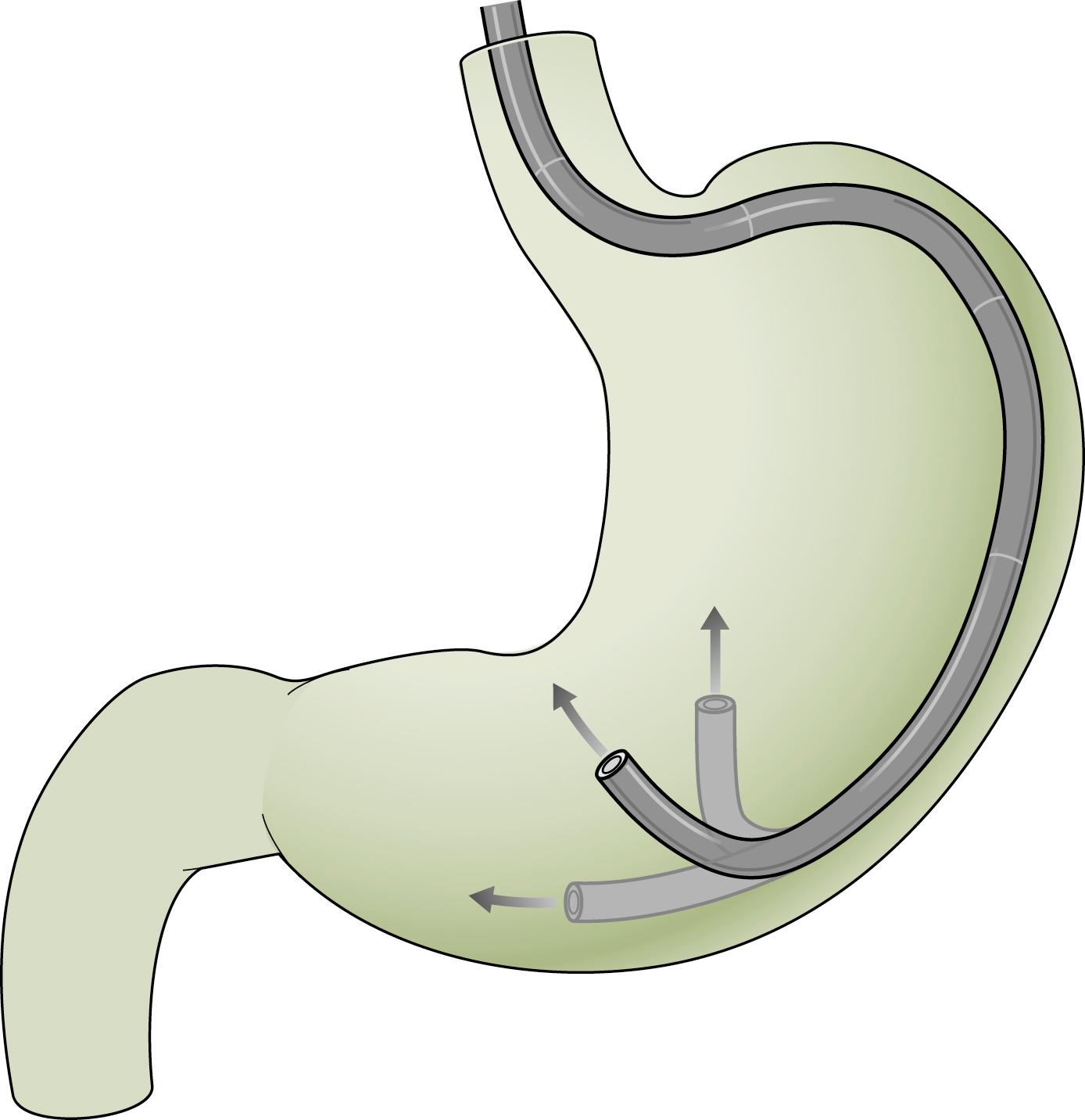 Fig. 60.5, Examination of the antrum and incisura by upward deflection of the endoscope tip.