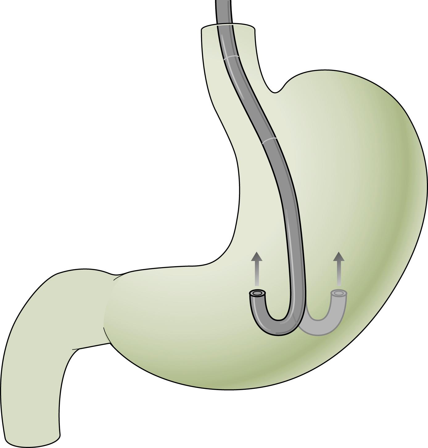 Fig. 60.6, Examination of the gastric cardia and fundus by retroflexion, scope withdrawal, and rotation.