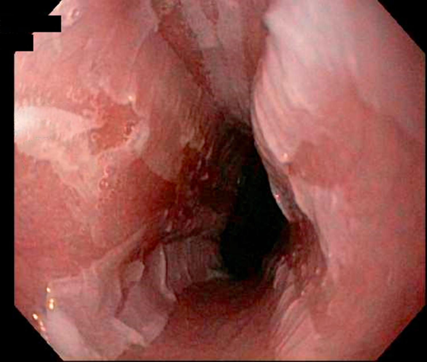 Fig. 60.8, Endoscopic appearance of esophagitis dissecans in a pediatric patient presenting with nausea and vomiting characterized by longitudinal mucosal sloughing in the mid-esophagus.