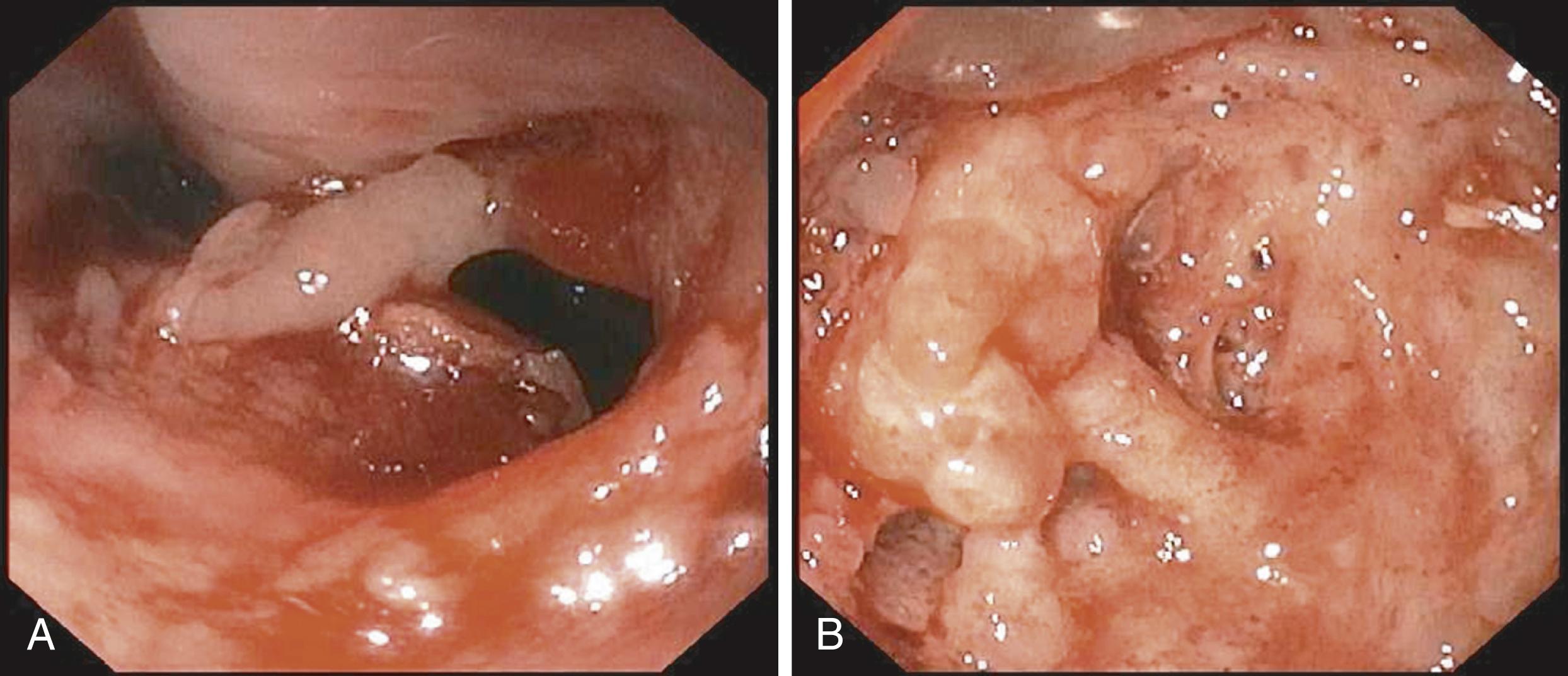 Fig. 60.9, (A) Large defect in the distal esophagus communicating with an excavating mass also associated with narrowing and deformity of the esophagus. (B) Fungating mass in the esophageal defect seen above, which was found to be nodular sclerosing Hodgkin lymphoma located in the posterior mediastinum and communicating with the esophagus. Dysphagia, epigastric pain, and weight loss were the patient’s initial presenting symptoms.