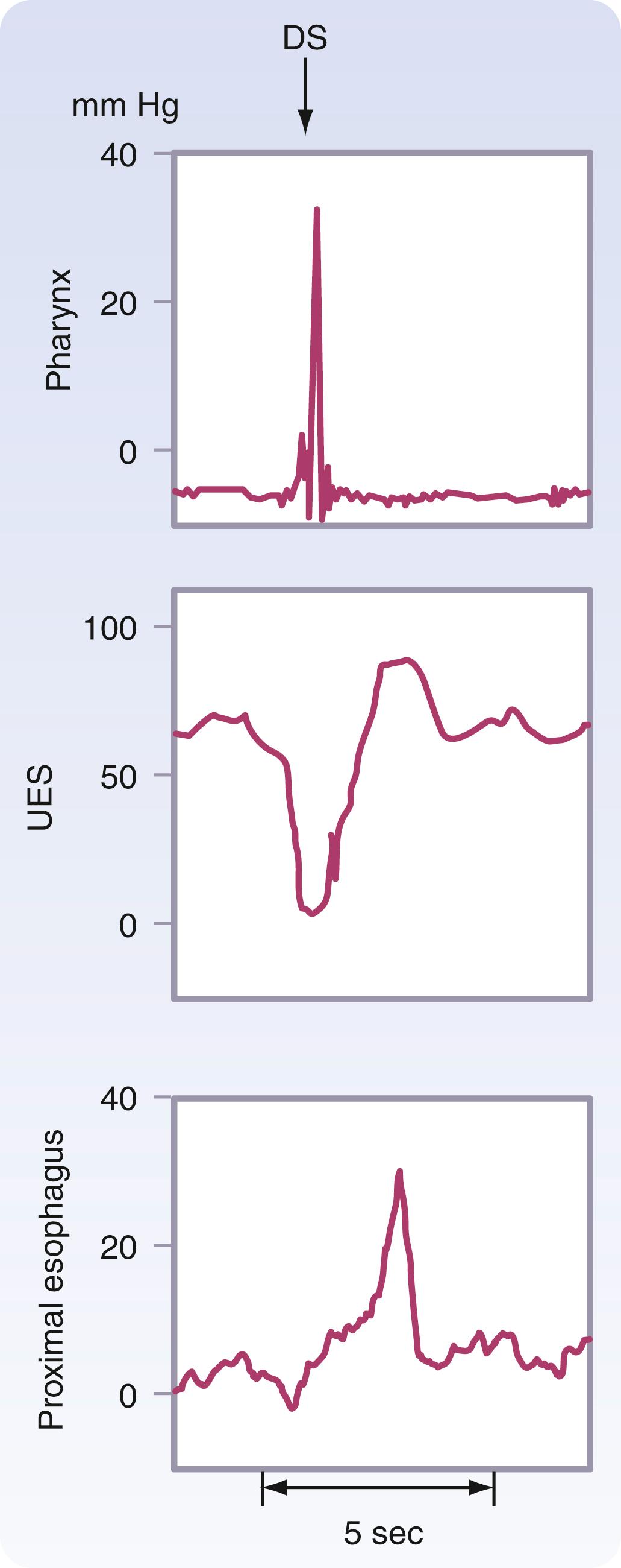 Fig. 42.13, Manometry of the upper esophageal sphincter (UES) .