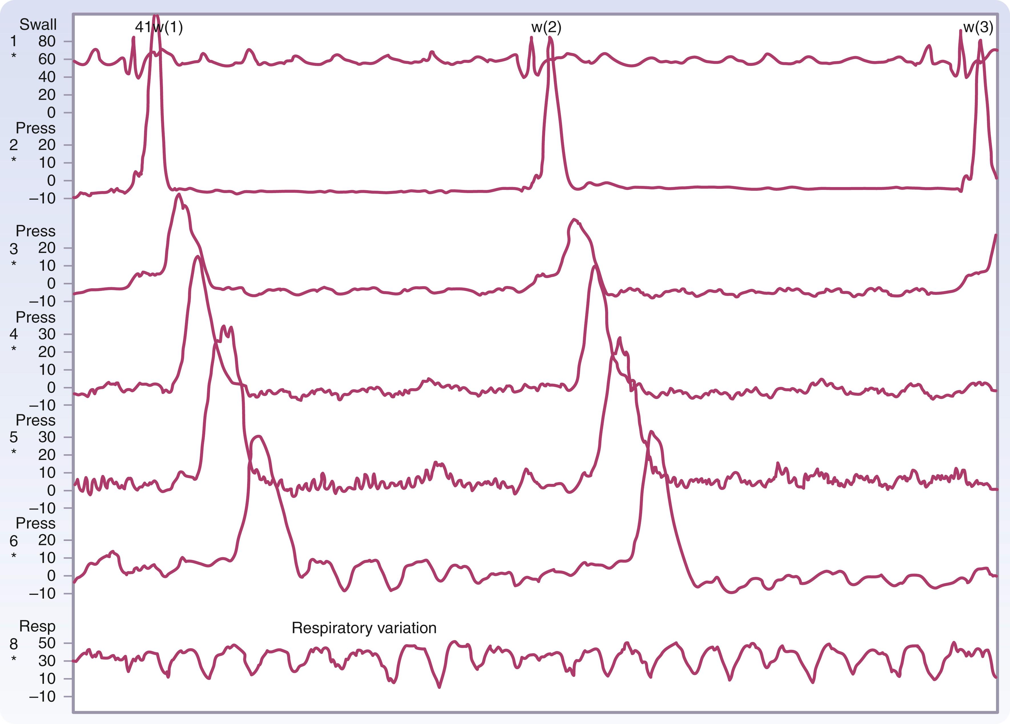 Fig. 42.14, Normal esophageal peristalsis.